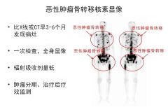 华人策略研究论坛核医学科骨检查与治疗